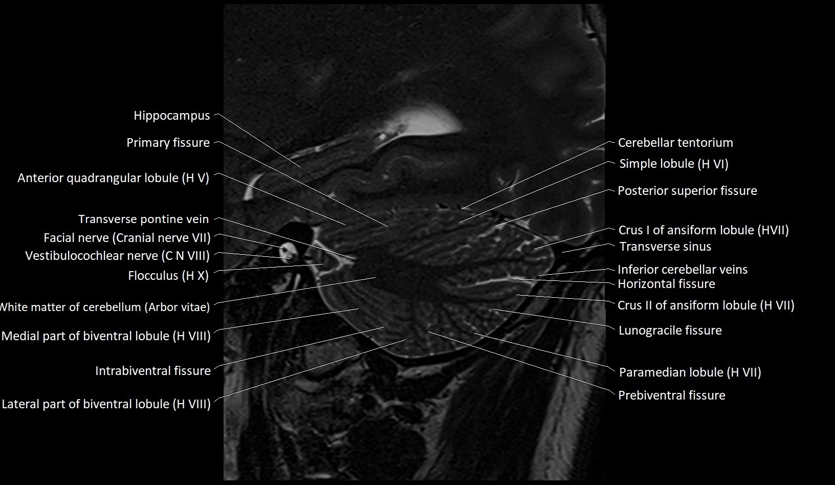 MRI Cerebellar anatomy sagittal High-resolution labelled image 15.webp
